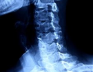 Radiographie cervicale